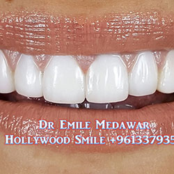 direct veneers
