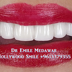 direct veneers