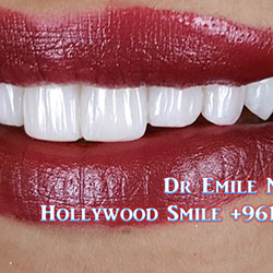 direct veneers
