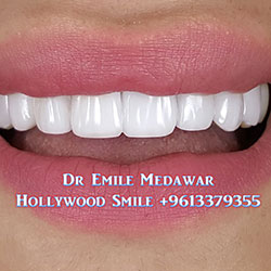 direct veneers