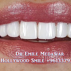 direct veneers