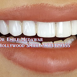 direct veneers
