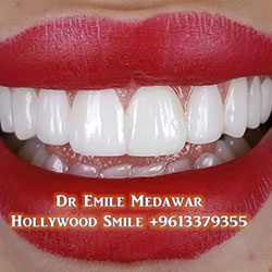 direct veneers