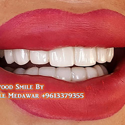 direct veneers