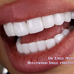 direct veneers