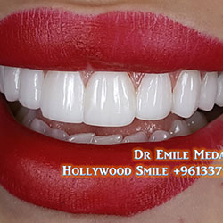 direct veneers