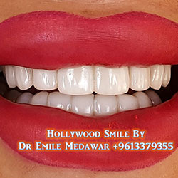 direct veneers