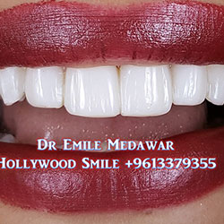 direct veneers