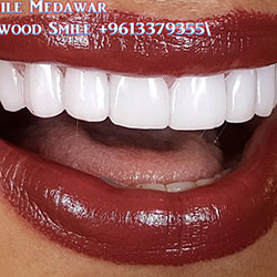 direct veneers