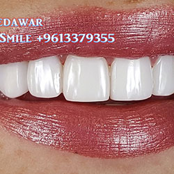 direct veneers