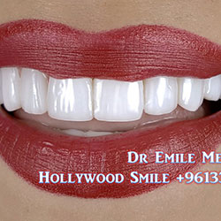 direct veneers
