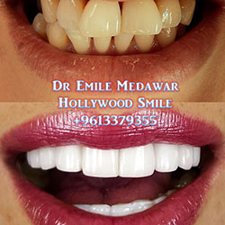 Prismatic Veneers Lebanon