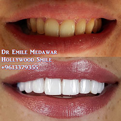 direct veneers