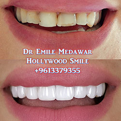 Lebanon beirut veneers