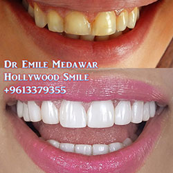 celebrity veneers lebanon beirut