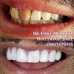 direct veneers