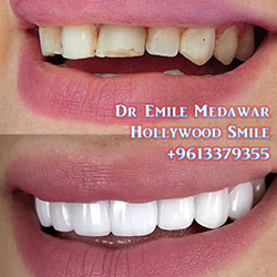 direct veneers