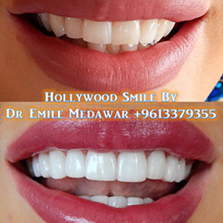 direct veneers