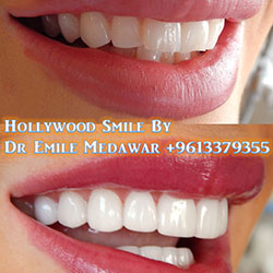 direct veneers
