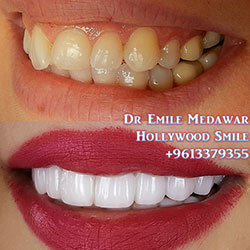 direct veneers