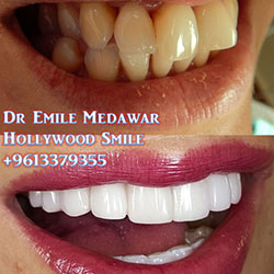 direct veneers lebanon beirut
