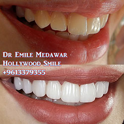 dentist lebanon veneers