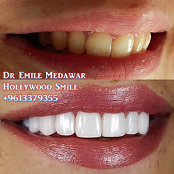 direct veneers smile beirut lebanon