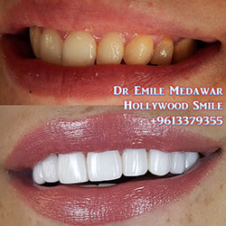 dental implants lebanon beirut