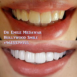direct veneers lebanon beirut