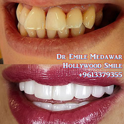 top veneers dentist lebanon beirut