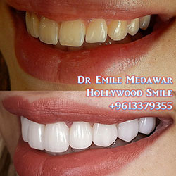 price of veneers in Lebanon beirut