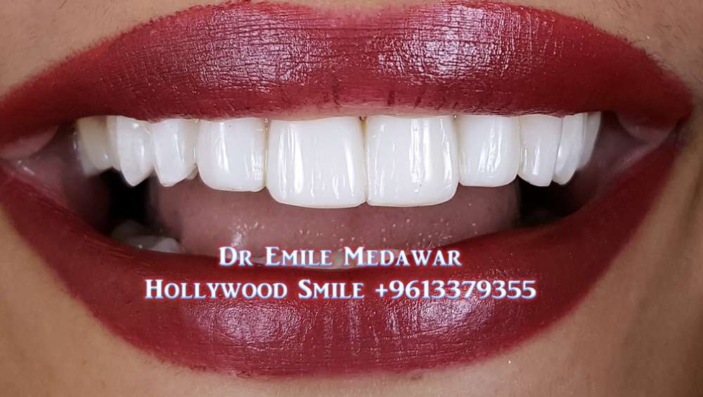 dental implants lebanon beirut