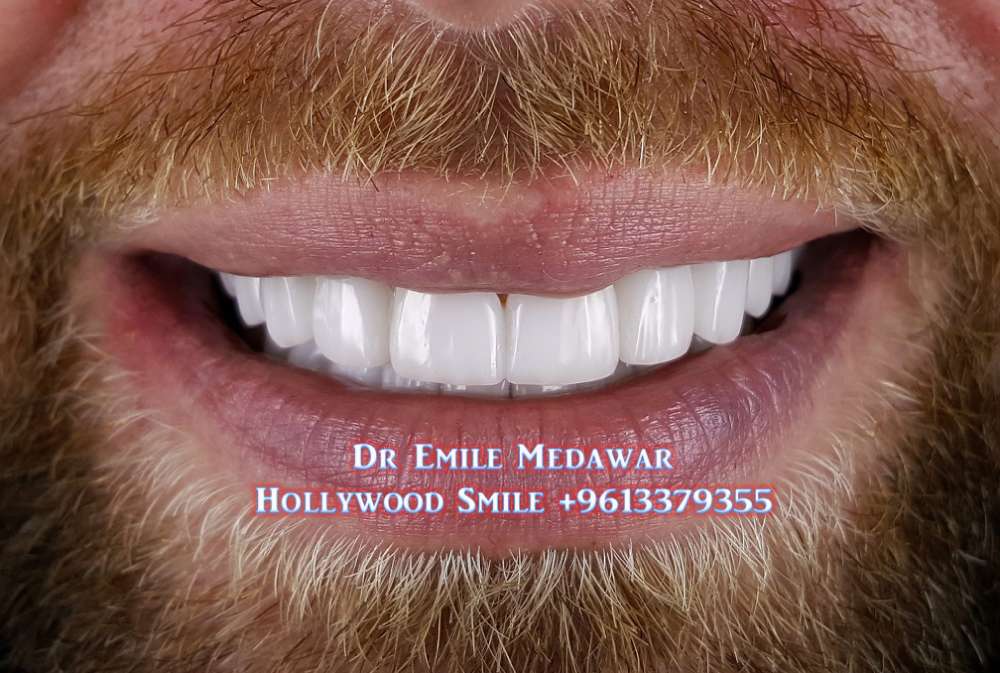 porcelain veneers lebanon