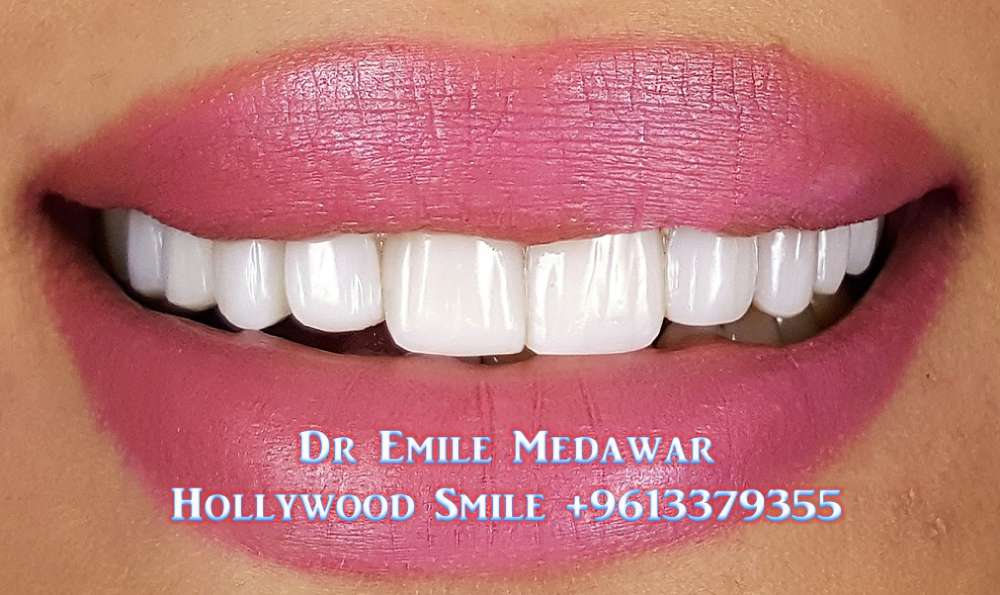 Hollywood Smile lebanon beirut
