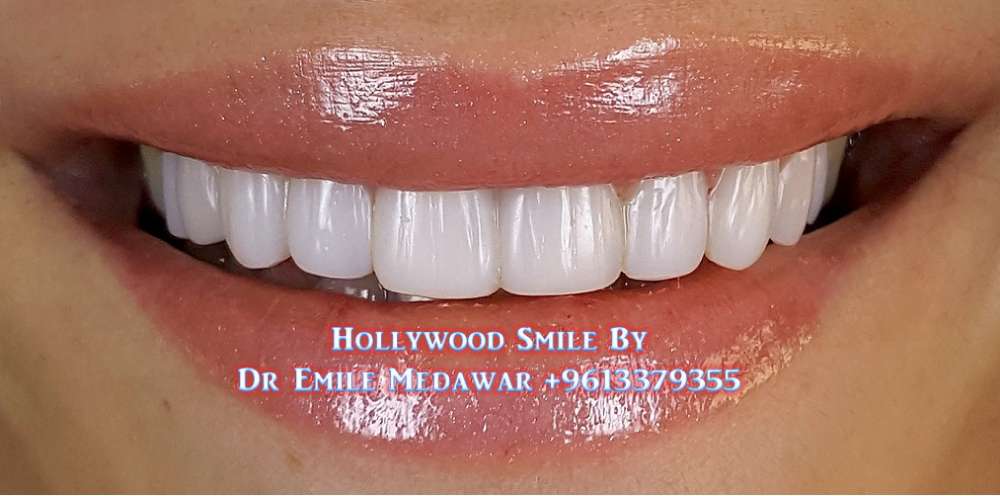 best veneers in Lebanon beirut