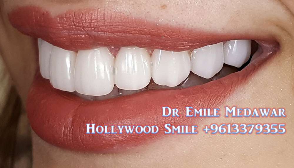 teeth whitening lebanon beirut