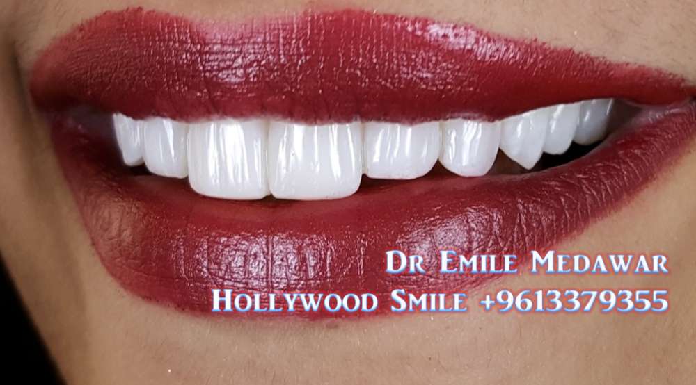 veneers lebanon beirut