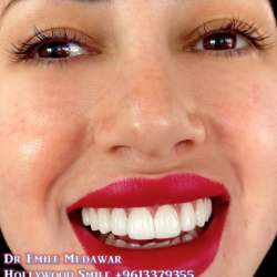 dental implants lebanon beirut