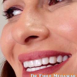 dental implants cost lebanon beirut