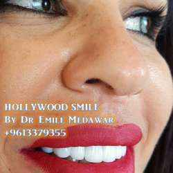 direct veneers