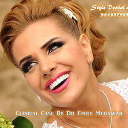 veneers in Lebanon beirut