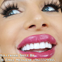 dental veneers lebanon beirut
