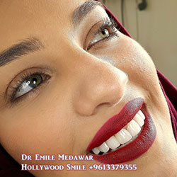 porcelain veneers lebanon