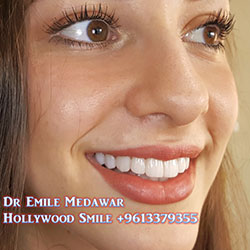 direct veneers lebanon beirut