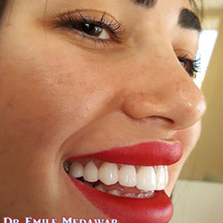 veneers price lebanon beirut