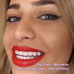 veneers cost lebanon beirut