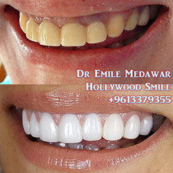 ZIRCONIUM HOLLYWOOD SMILE LEBANON