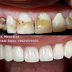 direct veneers