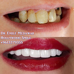 direct veneers