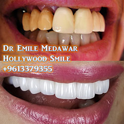 direct veneers